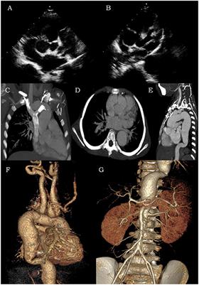 Case Report: Pediatric Chronic Active Epstein-Barr Virus Infection With Giant Sinus of Valsalva Aneurysms and Aorta and Its Branch Dilations